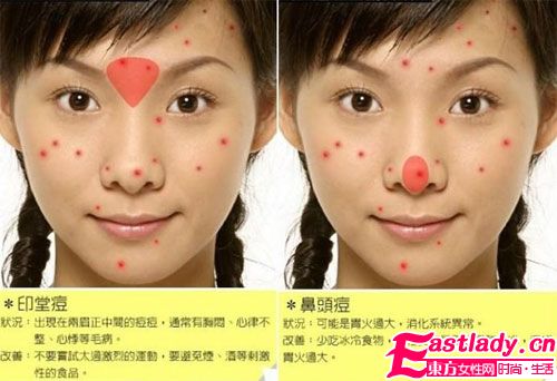 臉上長痘痘是什么原因造成的