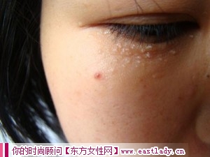 臉上長(zhǎng)脂肪粒是怎么回事