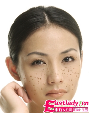 不同部位長(zhǎng)斑的原因