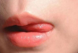 嘴上起泡是什么原因 該怎么治療