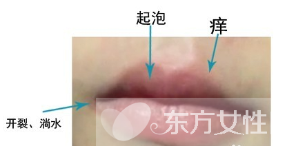 嘴上起泡是什么原因 該怎么治療