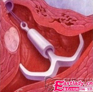 各種節(jié)育環(huán)的種類圖片介紹