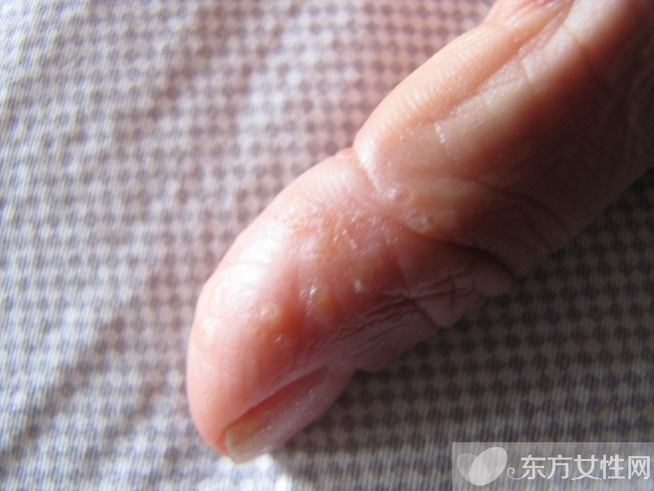 濕疹會傳染嗎 一些你不知道的治療濕疹小偏方推薦