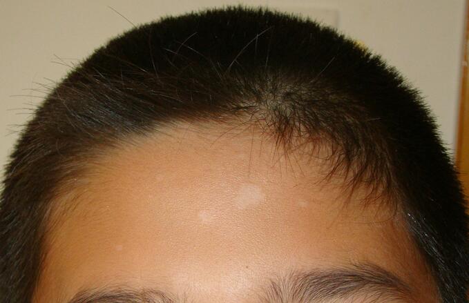 白色糠疹是什么 白色糠疹的病發(fā)原因是什么