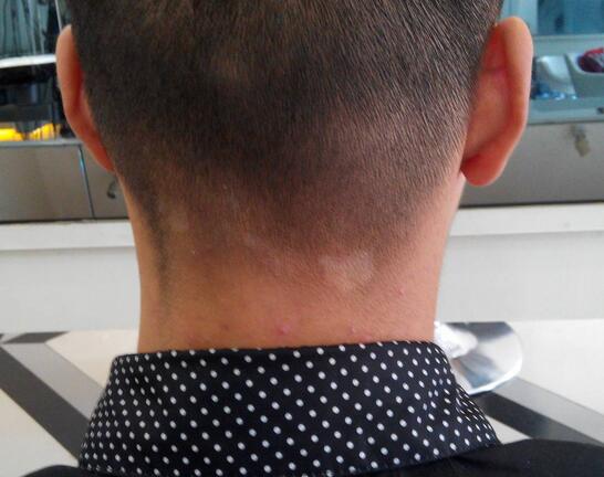 白色糠疹是什么 白色糠疹的病發(fā)原因是什么