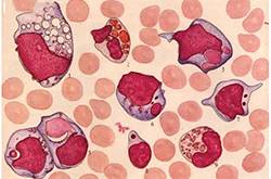 白細胞偏低的原因 白細胞低吃什么好
