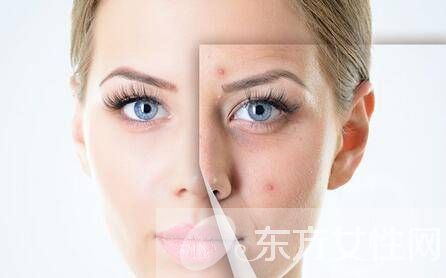 十大小偏方去粉刺痘痘 助你有效消除