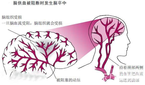 什么是腦卒中 這些細微的表現(xiàn)居然是它的早期癥狀