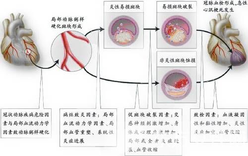 心肌缺血癥狀有哪些 注意休息和飲食最重要