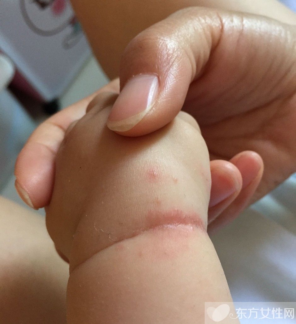 濕疹會傳染嗎 一些你不知道的治療濕疹小偏方推薦