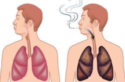 肺氣腫會傳染嗎 治療肺氣腫的食療偏方推薦