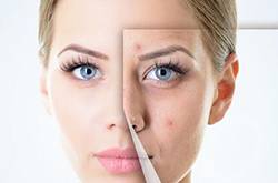 十大小偏方去粉刺痘痘 助你有效消除