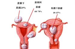 治療子宮肌瘤的偏方 這些居然是子宮肌瘤的早起癥狀