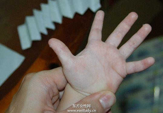 手上脫皮是怎么回事呢 輕松幾招讓你告別脫皮