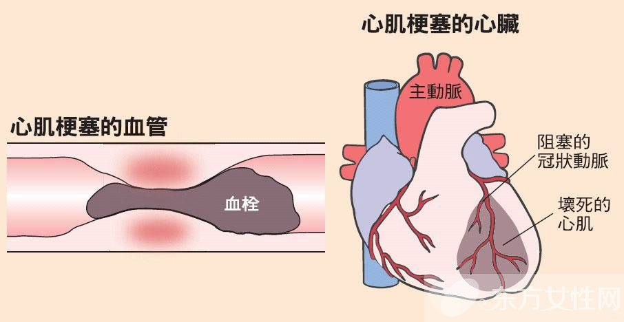 引發(fā)心肌梗塞的主要原因 這些早期癥狀一定要留意