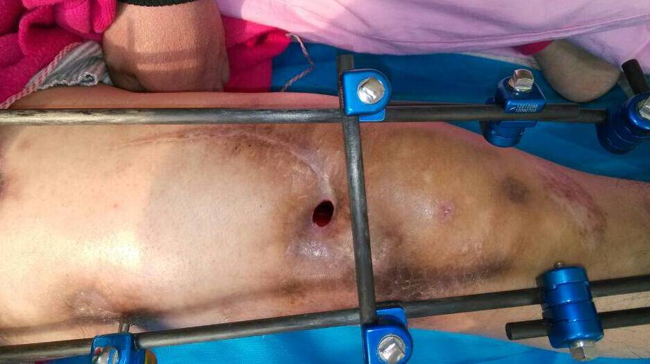 骨髓炎能治好嗎 揭秘骨髓炎癥狀危害