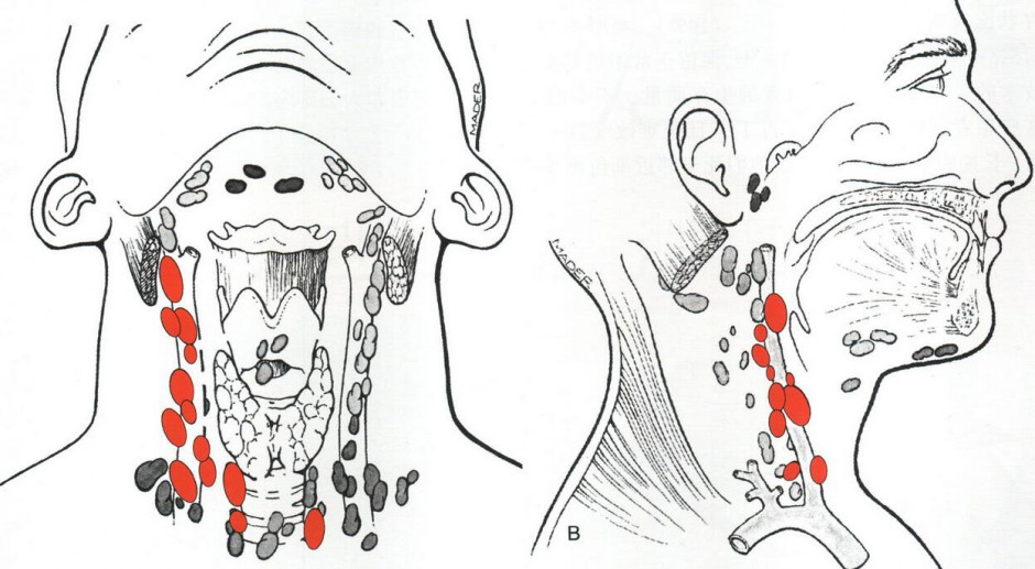 甲狀腺癌術(shù)后飲食禁忌 解讀甲狀腺癌各類癥狀