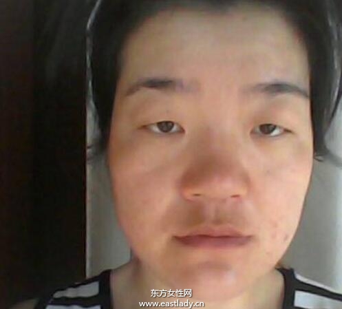 上眼皮突然下垂怎么辦 這可能是疾病信號