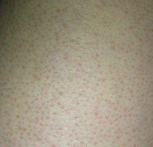 毛周角化是什么 揭你所不知的 雞皮膚 治療