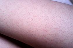 毛周角化是什么 揭你所不知的 雞皮膚 治療