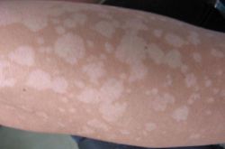 汗斑如何預(yù)防 薦5個(gè)有效治療小妙招