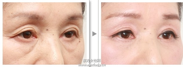 上眼皮突然下垂怎么辦 這可能是疾病信號