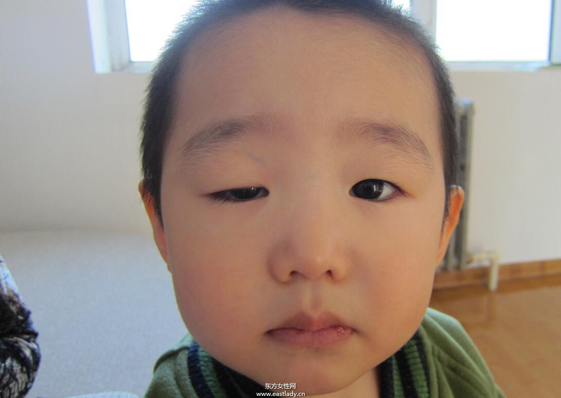 上眼皮突然下垂怎么辦 這可能是疾病信號(hào)