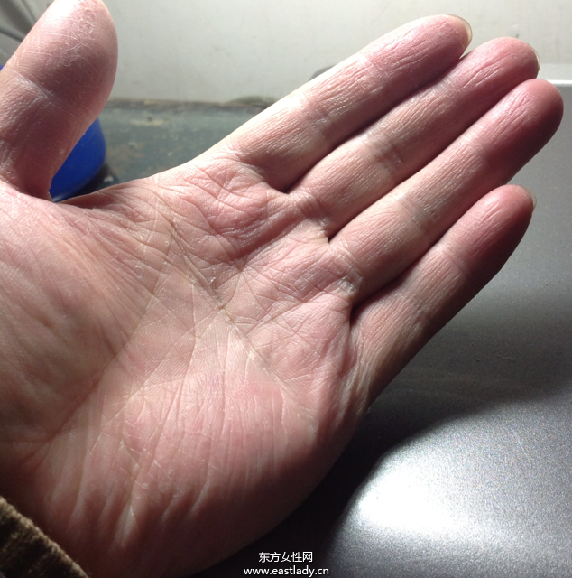 手上脫皮是怎么回事呢 輕松幾招讓你告別脫皮