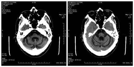 小腦萎縮的誘因及癥狀 小腦萎縮吃什么好