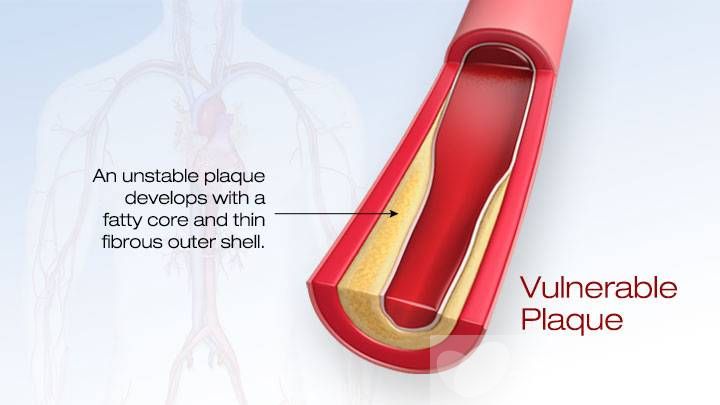高血脂的治療與飲食 最見效的食療方法推薦