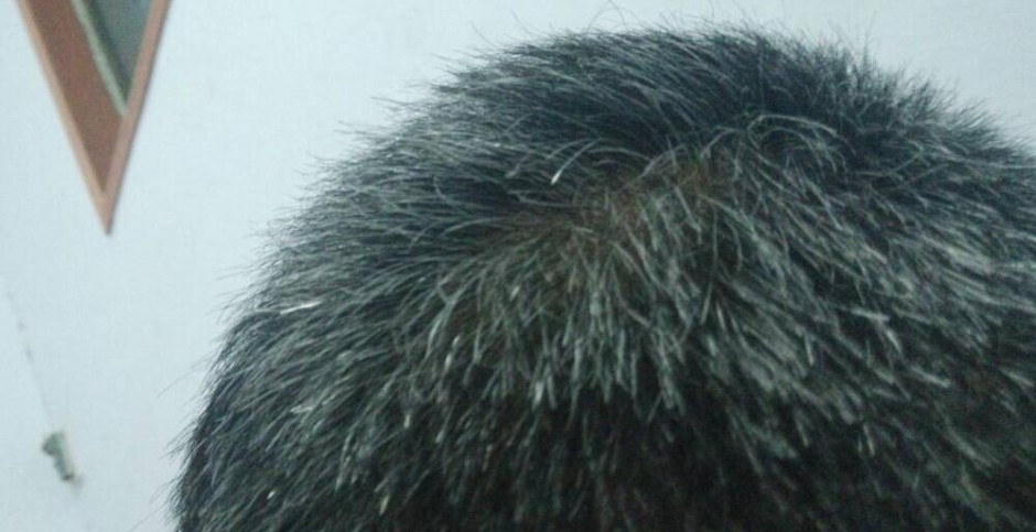 頭發(fā)變白形成原因 看哪些你已中招