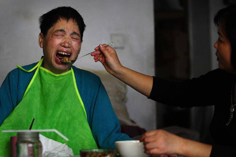 小腦萎縮的誘因及癥狀 小腦萎縮吃什么好