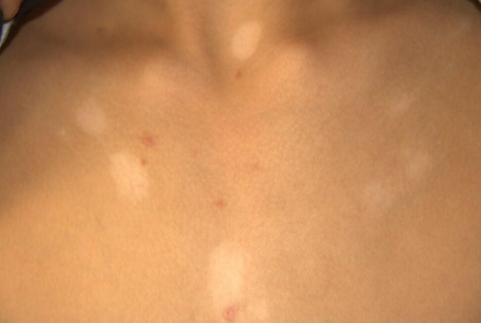 汗斑如何預防 薦5個有效治療小妙招