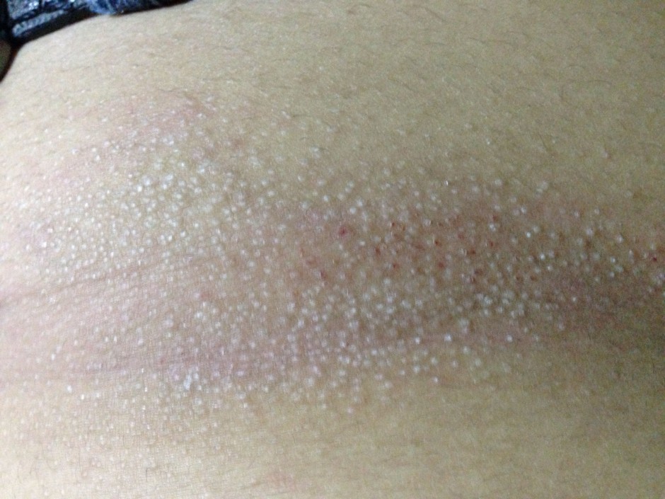 毛周角化是什么 揭你所不知的 雞皮膚 治療