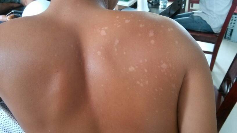 汗斑如何預防 薦5個有效治療小妙招