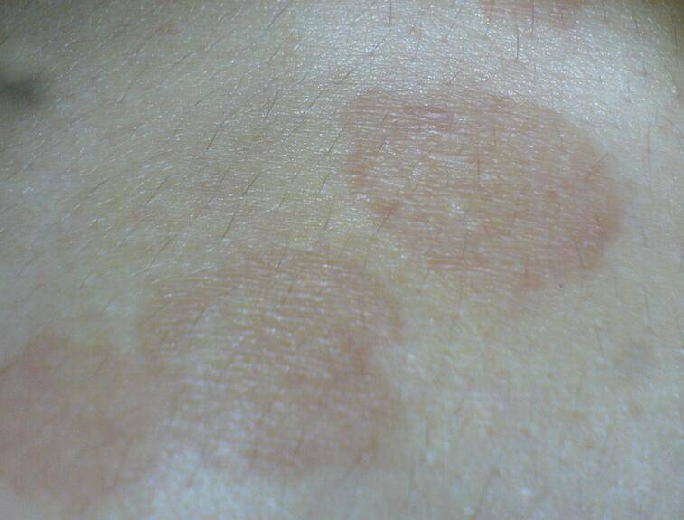 花斑癬如何預(yù)防 治療花斑癬的小偏方介紹