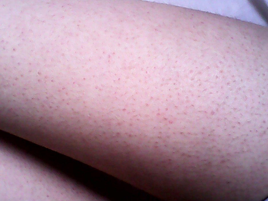 毛周角化是什么 揭你所不知的 雞皮膚 治療