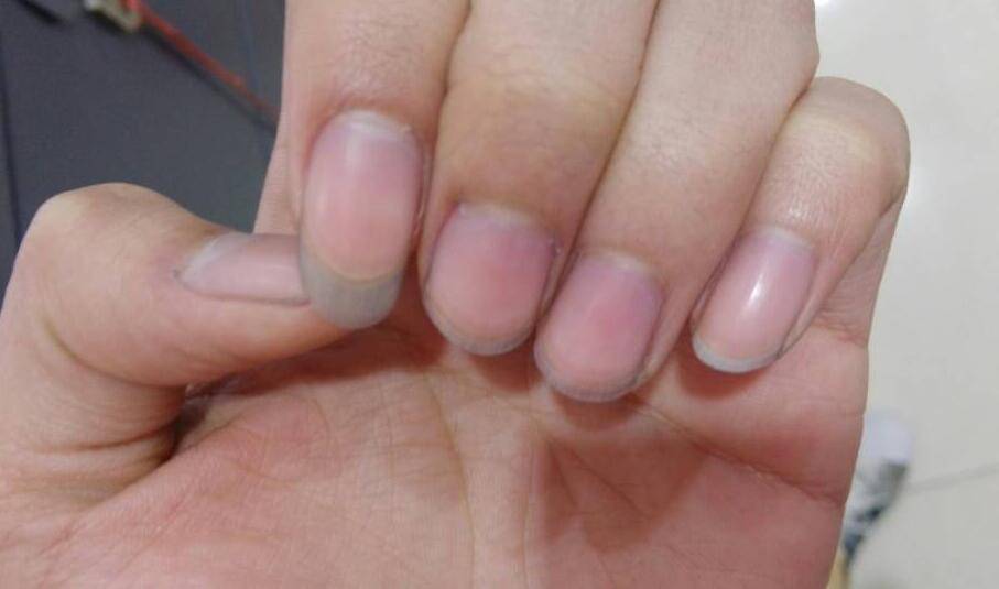 6個治療灰指甲的小偏方 灰指甲怎么預(yù)防