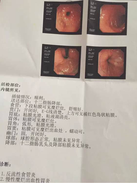 胃出血常見5大癥狀 胃出血最佳治療方法