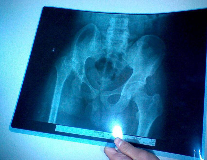 股骨頭壞死四大常見(jiàn)癥狀 9款食療助康復(fù)