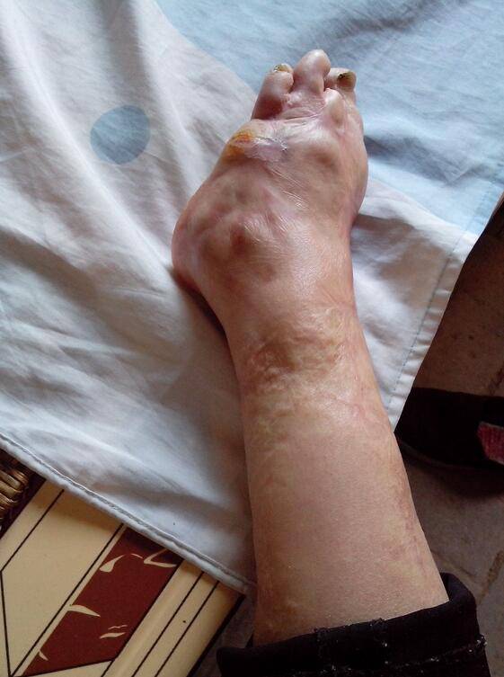 骨髓炎能治好嗎 揭秘骨髓炎癥狀危害