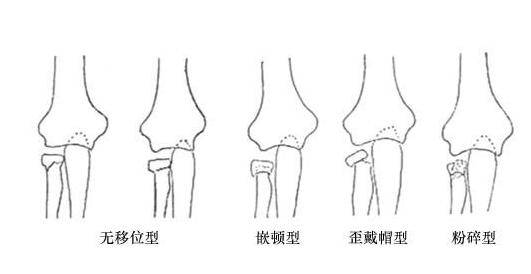 骨折愈合時(shí)間需要多久 愈合康復(fù)訓(xùn)練