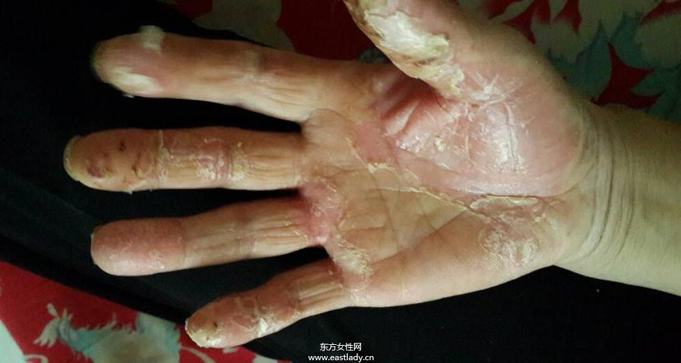 手上脫皮是怎么回事呢 輕松幾招讓你告別脫皮