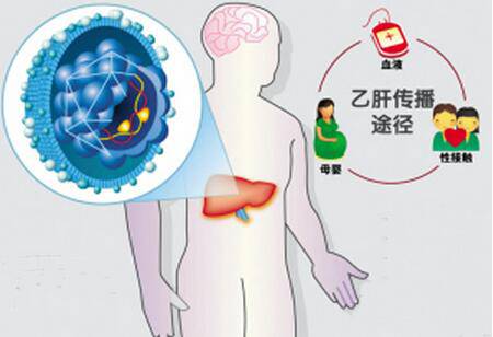 乙肝會(huì)傳染嗎 預(yù)防傳染千萬別做這些事
