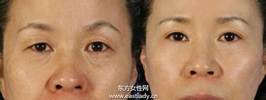 上眼皮突然下垂怎么辦 這可能是疾病信號(hào)