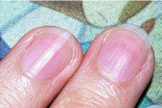 指甲上有豎紋是怎么回事 5個(gè)妙招教你如何調(diào)理