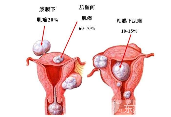 治療子宮肌瘤的偏方 這些居然是子宮肌瘤的早起癥狀
