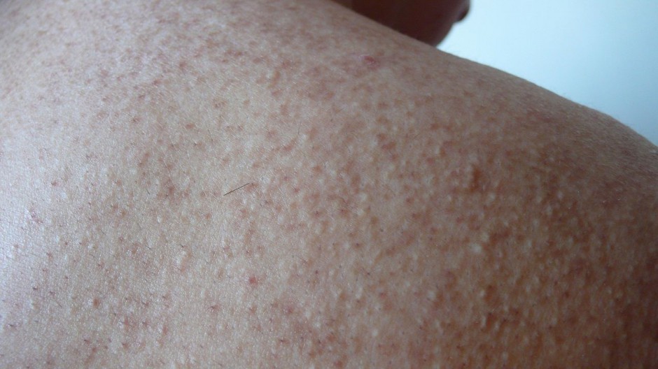 毛周角化是什么 揭你所不知的 雞皮膚 治療