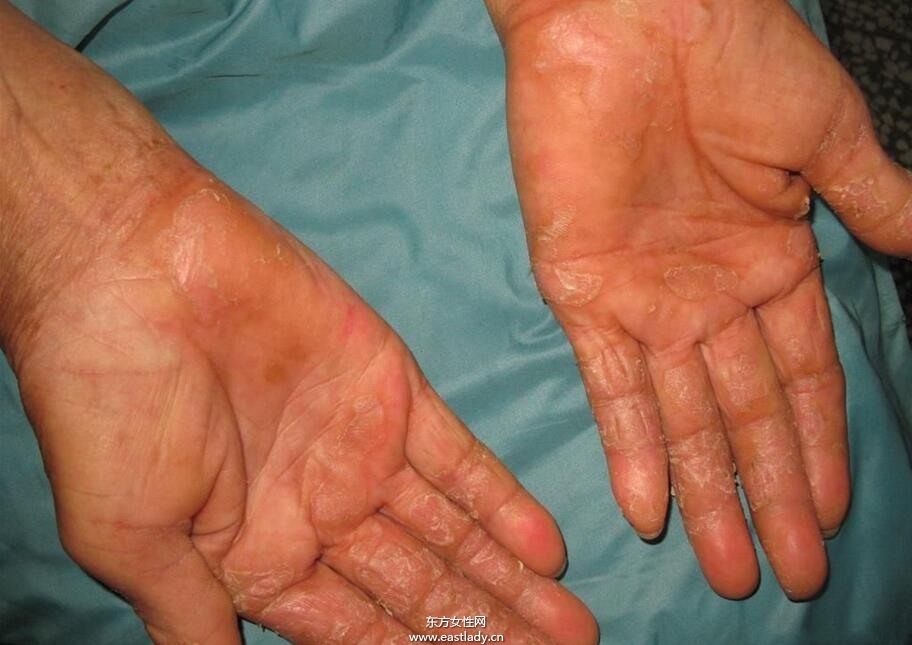 手上脫皮是怎么回事呢 輕松幾招讓你告別脫皮