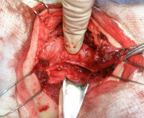 甲狀腺癌術(shù)后飲食禁忌 解讀甲狀腺癌各類癥狀